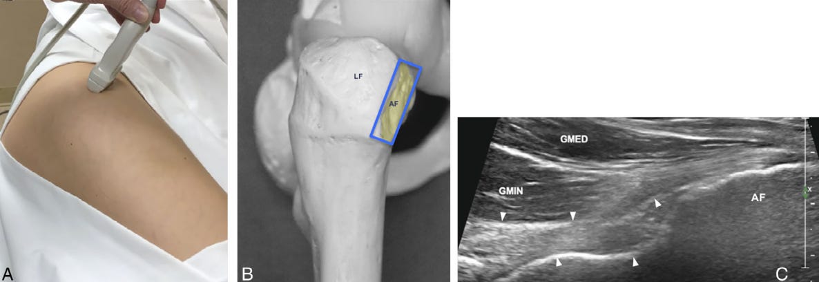 4. Tendon gluteo menor ecografia tempo formacion.jpg